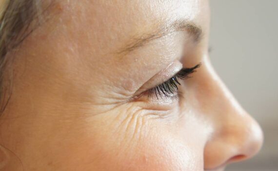 Cómo eliminar las arrugas de manera natural